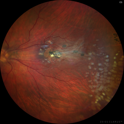Familial Exudative Vitreoretinopathy - FEVR - Stage 1-b both eyes
She was born at term.Â Â Â No family history of eye disease.
VA OD: Dcc20/25, VA OS: Dcc20/200+1 Ncc20/400
Anterior segment normal â€“ clear lenses
