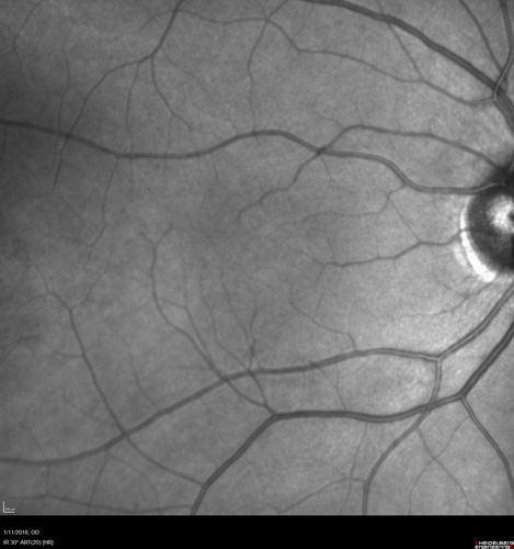 Foveal Red Spot Syndrome Left Eye
She noticed on covering the right eye that she had distortion off center in the left eye a few weeks ago.Â  She had a temporal paracentral scotoma intermittently visible on the eye examination.Â  She does notice that the left eye is not as good as the right eye now that it has been brought to her attention.Â  She has every now and then a little twitch in the left eye.Â  She has no pain on eye motion.Â Â 
VA OD: sc20/20 NccJ1+
VA OS: sc20/20-1
