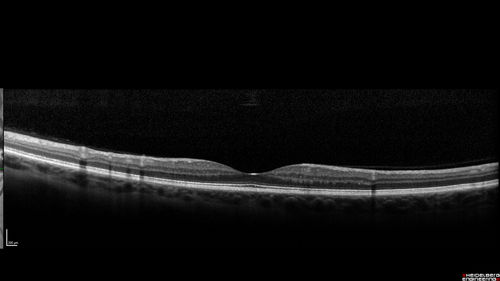 Foveal Red Spot Syndrome Left Eye
She noticed on covering the right eye that she had distortion off center in the left eye a few weeks ago.Â  She had a temporal paracentral scotoma intermittently visible on the eye examination.Â  She does notice that the left eye is not as good as the right eye now that it has been brought to her attention.Â  She has every now and then a little twitch in the left eye.Â  She has no pain on eye motion.Â Â 
VA OD: sc20/20 NccJ1+
VA OS: sc20/20-1
