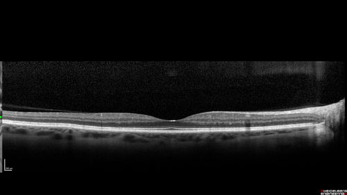 Foveal Red Spot Syndrome Left Eye
She noticed on covering the right eye that she had distortion off center in the left eye a few weeks ago.Â  She had a temporal paracentral scotoma intermittently visible on the eye examination.Â  She does notice that the left eye is not as good as the right eye now that it has been brought to her attention.Â  She has every now and then a little twitch in the left eye.Â  She has no pain on eye motion.Â Â 
VA OD: sc20/20 NccJ1+
VA OS: sc20/20-1
