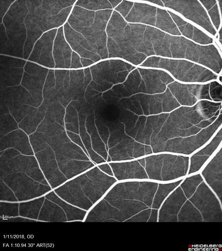 Foveal Red Spot Syndrome Left Eye
She noticed on covering the right eye that she had distortion off center in the left eye a few weeks ago.Â  She had a temporal paracentral scotoma intermittently visible on the eye examination.Â  She does notice that the left eye is not as good as the right eye now that it has been brought to her attention.Â  She has every now and then a little twitch in the left eye.Â  She has no pain on eye motion.Â Â 
VA OD: sc20/20 NccJ1+
VA OS: sc20/20-1
