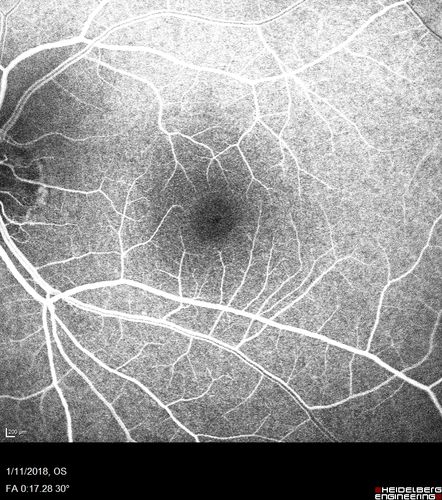 Foveal Red Spot Syndrome Left Eye
She noticed on covering the right eye that she had distortion off center in the left eye a few weeks ago.Â  She had a temporal paracentral scotoma intermittently visible on the eye examination.Â  She does notice that the left eye is not as good as the right eye now that it has been brought to her attention.Â  She has every now and then a little twitch in the left eye.Â  She has no pain on eye motion.Â Â 
VA OD: sc20/20 NccJ1+
VA OS: sc20/20-1

