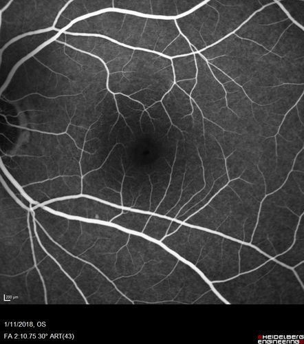 Foveal Red Spot Syndrome Left Eye
She noticed on covering the right eye that she had distortion off center in the left eye a few weeks ago.Â  She had a temporal paracentral scotoma intermittently visible on the eye examination.Â  She does notice that the left eye is not as good as the right eye now that it has been brought to her attention.Â  She has every now and then a little twitch in the left eye.Â  She has no pain on eye motion.Â Â 
VA OD: sc20/20 NccJ1+
VA OS: sc20/20-1
