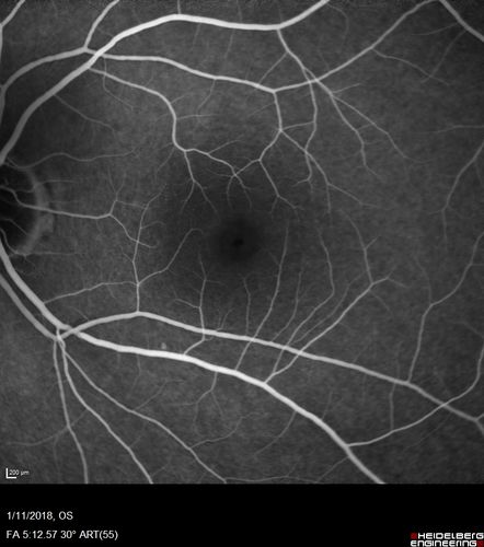 Foveal Red Spot Syndrome Left Eye
She noticed on covering the right eye that she had distortion off center in the left eye a few weeks ago.Â  She had a temporal paracentral scotoma intermittently visible on the eye examination.Â  She does notice that the left eye is not as good as the right eye now that it has been brought to her attention.Â  She has every now and then a little twitch in the left eye.Â  She has no pain on eye motion.Â Â 
VA OD: sc20/20 NccJ1+
VA OS: sc20/20-1
