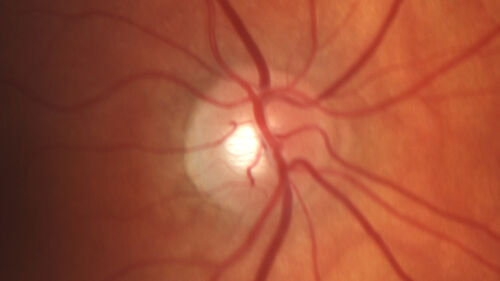 Arteritic Anterior Ischmic Optic Neuropathy Left Eye
78 year old female with 5 day history of decreased vision in the left eye (sudden onset)  She has been treated for GCA but her steroids were tapered down to 20 mg daily and she is not feeling well since the taper:
VA 20/20 OD, 20/25 OS ( APD OS)
