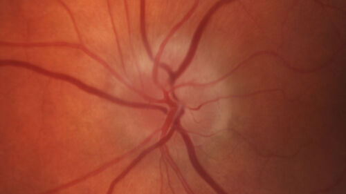 Arteritic Anterior Ischmic Optic Neuropathy Left Eye
78 year old female with 5 day history of decreased vision in the left eye (sudden onset)  She has been treated for GCA but her steroids were tapered down to 20 mg daily and she is not feeling well since the taper:
VA 20/20 OD, 20/25 OS ( APD OS)
