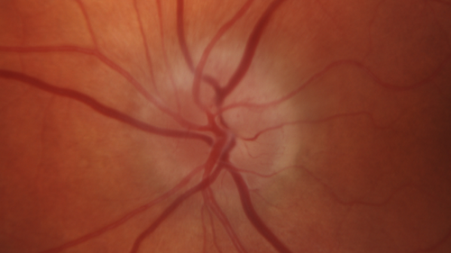Giant Cell Arteritis - Anterior Ischemic Optic Neuropathy - Left Eye
78 year old female with vision loss on steroid taper for GCA.  Superior pole of optic nerve left eye is swollen
