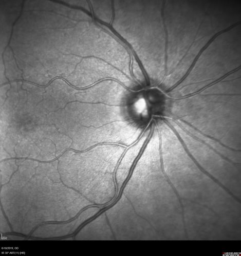 Giant Cell Arteritis - Anterior Ischemic Optic Neuropathy - Left Eye
78 year old female with vision loss on steroid taper for GCA.  Superior pole of optic nerve left eye is swollen
