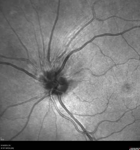 Giant Cell Arteritis - Anterior Ischemic Optic Neuropathy - Left Eye
78 year old female with vision loss on steroid taper for GCA.  Superior pole of optic nerve left eye is swollen
