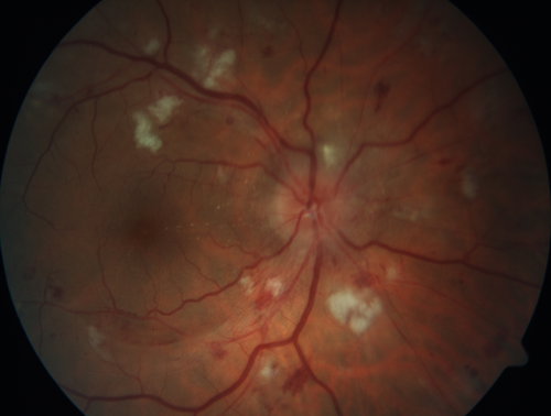 Grade 4 hypertensive retinopathy
55 year old man Hhe did have headaches a few weeks ago and also some nausea and vomiting.  He noticed for a few weeks the vision in the left eye was blurred and  that the vision in the left eye is dark.  
VA OD: Dcc20/20 
VA OS: Dcc20/100-1

He was admitted directly to ICU for blood pressure control (290 / 170 mmHg)
3 weeks later his VA increased to 20/20 OD, 20/32 OS
