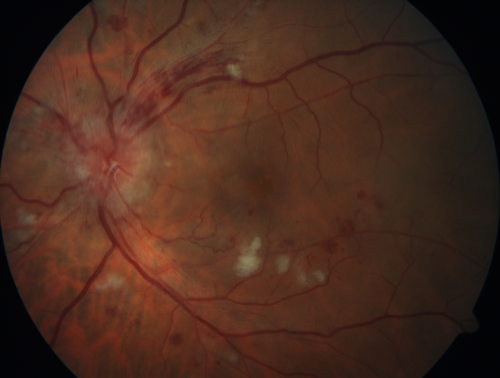 Grade 4 hypertensive retinopathy
55 year old man Hhe did have headaches a few weeks ago and also some nausea and vomiting.  He noticed for a few weeks the vision in the left eye was blurred and  that the vision in the left eye is dark.  
VA OD: Dcc20/20 
VA OS: Dcc20/100-1

He was admitted directly to ICU for blood pressure control (290 / 170 mmHg)
3 weeks later his VA increased to 20/20 OD, 20/32 OS
