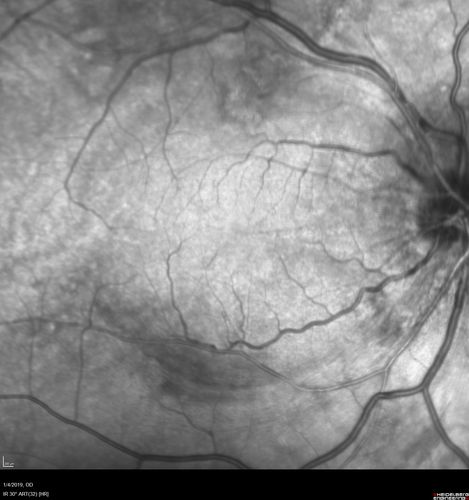 Grade 4 hypertensive retinopathy
55 year old man Hhe did have headaches a few weeks ago and also some nausea and vomiting.  He noticed for a few weeks the vision in the left eye was blurred and  that the vision in the left eye is dark.  
VA OD: Dcc20/20 
VA OS: Dcc20/100-1

He was admitted directly to ICU for blood pressure control (290 / 170 mmHg)
3 weeks later his VA increased to 20/20 OD, 20/32 OS
