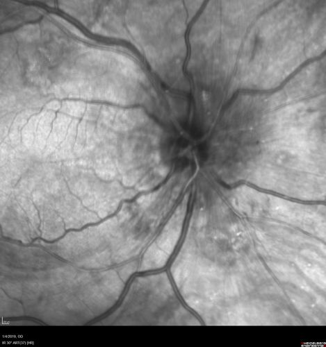 Grade 4 hypertensive retinopathy
55 year old man Hhe did have headaches a few weeks ago and also some nausea and vomiting.  He noticed for a few weeks the vision in the left eye was blurred and  that the vision in the left eye is dark.  
VA OD: Dcc20/20 
VA OS: Dcc20/100-1

He was admitted directly to ICU for blood pressure control (290 / 170 mmHg)
3 weeks later his VA increased to 20/20 OD, 20/32 OS
