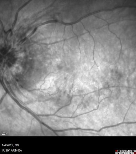 Grade 4 hypertensive retinopathy
55 year old man Hhe did have headaches a few weeks ago and also some nausea and vomiting.  He noticed for a few weeks the vision in the left eye was blurred and  that the vision in the left eye is dark.  
VA OD: Dcc20/20 
VA OS: Dcc20/100-1

He was admitted directly to ICU for blood pressure control (290 / 170 mmHg)
3 weeks later his VA increased to 20/20 OD, 20/32 OS
