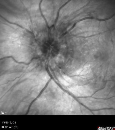 Grade 4 hypertensive retinopathy
55 year old man Hhe did have headaches a few weeks ago and also some nausea and vomiting.  He noticed for a few weeks the vision in the left eye was blurred and  that the vision in the left eye is dark.  
VA OD: Dcc20/20 
VA OS: Dcc20/100-1

He was admitted directly to ICU for blood pressure control (290 / 170 mmHg)
3 weeks later his VA increased to 20/20 OD, 20/32 OS
