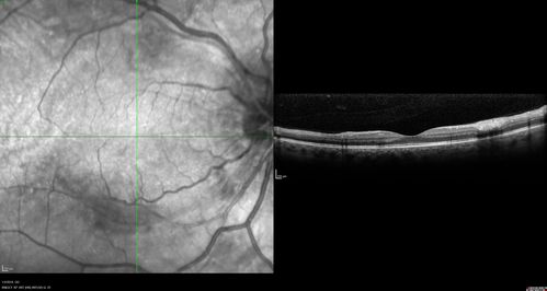 Grade 4 hypertensive retinopathy
55 year old man Hhe did have headaches a few weeks ago and also some nausea and vomiting.  He noticed for a few weeks the vision in the left eye was blurred and  that the vision in the left eye is dark.  
VA OD: Dcc20/20 
VA OS: Dcc20/100-1

He was admitted directly to ICU for blood pressure control (290 / 170 mmHg)
3 weeks later his VA increased to 20/20 OD, 20/32 OS
