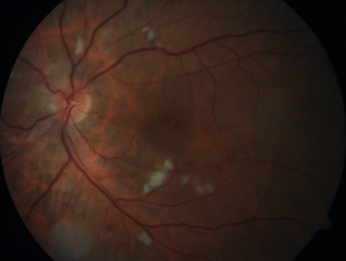 Grade 4 hypertensive retinopathy
55 year old man Hhe did have headaches a few weeks ago and also some nausea and vomiting.  He noticed for a few weeks the vision in the left eye was blurred and  that the vision in the left eye is dark.  
VA OD: Dcc20/20 
VA OS: Dcc20/100-1

He was admitted directly to ICU for blood pressure control (290 / 170 mmHg)
3 weeks later his VA increased to 20/20 OD, 20/32 OS
