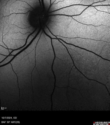 Choroidal Nevus with Halo
