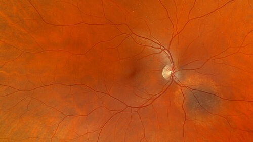 Choroidal Nevus with Halo
