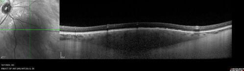 Choroidal Nevus with Halo
