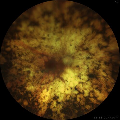 Pan Retinal Laser from original DRS study in the 1970s - 50 years later
67 year old female with diabetes since age 8.  She had heavy PRP laser to both eyes in the 1970s by Lloyd M. Aiello, M.D, the father of PRP laser.  Her vision is poor now, 1/200 OD and 20/200 OS.
