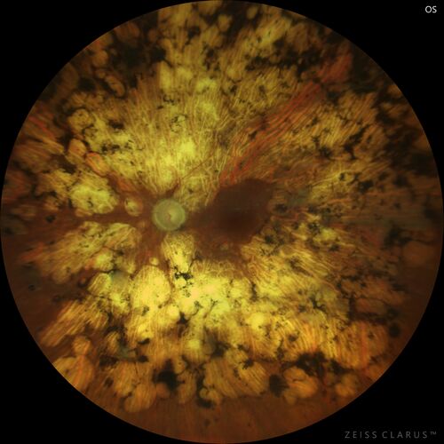 Pan Retinal Laser from original DRS study in the 1970s - 50 years later
67 year old female with diabetes since age 8.  She had heavy PRP laser to both eyes in the 1970s by Lloyd M. Aiello, M.D, the father of PRP laser.  Her vision is poor now, 1/200 OD and 20/200 OS.
