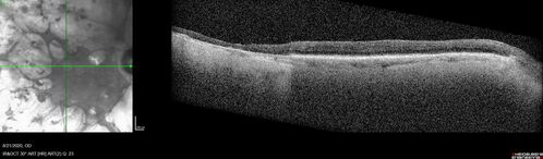 Pan Retinal Laser from original DRS study in the 1970s - 50 years later
67 year old female with diabetes since age 8.  She had heavy PRP laser to both eyes in the 1970s by Lloyd M. Aiello, M.D, the father of PRP laser.  Her vision is poor now, 1/200 OD and 20/200 OS.
