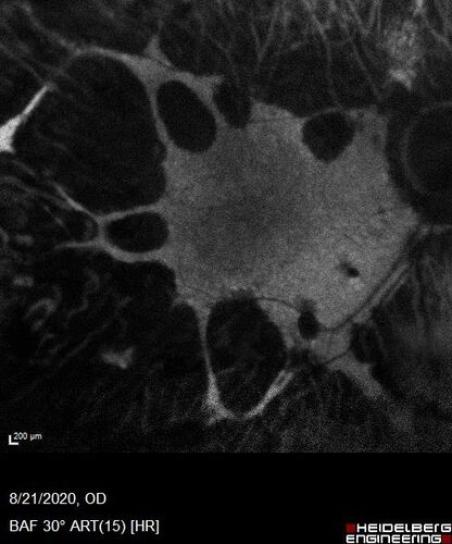 Pan Retinal Laser from original DRS study in the 1970s - 50 years later
67 year old female with diabetes since age 8.  She had heavy PRP laser to both eyes in the 1970s by Lloyd M. Aiello, M.D, the father of PRP laser.  Her vision is poor now, 1/200 OD and 20/200 OS.
