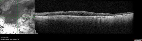 Pan Retinal Laser from original DRS study in the 1970s - 50 years later
67 year old female with diabetes since age 8.  She had heavy PRP laser to both eyes in the 1970s by Lloyd M. Aiello, M.D, the father of PRP laser.  Her vision is poor now, 1/200 OD and 20/200 OS.
