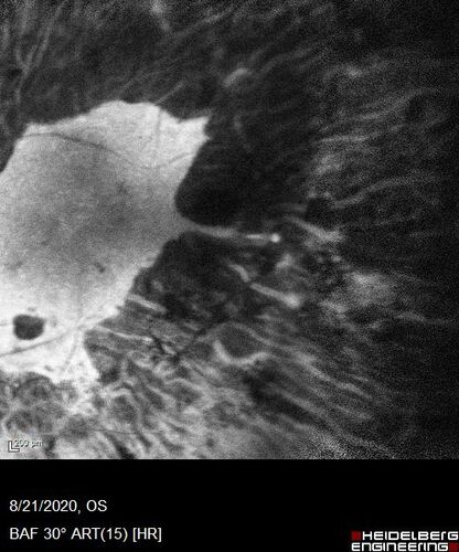 Pan Retinal Laser from original DRS study in the 1970s - 50 years later
67 year old female with diabetes since age 8.  She had heavy PRP laser to both eyes in the 1970s by Lloyd M. Aiello, M.D, the father of PRP laser.  Her vision is poor now, 1/200 OD and 20/200 OS.
