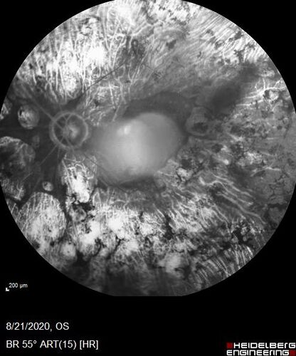 Pan Retinal Laser from original DRS study in the 1970s - 50 years later
67 year old female with diabetes since age 8.  She had heavy PRP laser to both eyes in the 1970s by Lloyd M. Aiello, M.D, the father of PRP laser.  Her vision is poor now, 1/200 OD and 20/200 OS.

