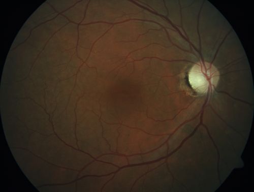 Autosomal Dominant Optic Atrophy - Father
52 year old man Vision has not been correctable for many years.  
EXTENDED HPI: The patient has been seen for a while and his vision is not normal.Â Â 
VA OD: sc20/100 PH20/50-1 Nsc20/400
VA OS: sc20/63 PH20/50-2 NscJ16
IOP: TP: OD:10 OS:9 Time:02:29 PM
Two siblings and his son have the same problem
