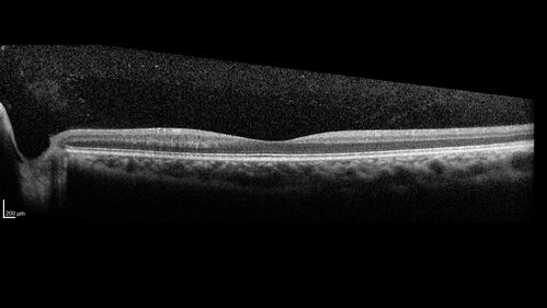 Autosomal Dominant Optic Atrophy - Son
12 year old man.  His vision was not correctable to 20/20.  There was concern about possible macula problem.Â  His was diagnosed with Streff syndrome in NY.
VA OD: Dcc20/63 PH20/50-2 NccJ2
VA OS: Dcc20/63 PH20/50-2 NccJ3
IOP: TP: OD:10 OS:15 Time:02:24 PM
The diagnostic criteria for Streff syndrome are not well established, and the validity of this condition has not been recognized by The American Academy of Ophthalmology, The American Academy of Pediatric Ophthalmology, The American Academy of Optometry or The American academy of Pediatrics.
