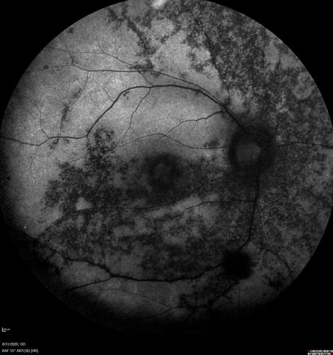 hydroxychloroquine (Plaquenil) Toxicity - Taiwanese - 3 years post stopping
59 year old female on 400 mg plaquenil for 22 years. 3 years ago, when stopping plaquenil, VA 20/50 both eyes.  Plaquenil was stopped.  The vision in the left eye continued to deteriorate to 3/200.  5'2" 127 lb (6.6 mg/kg body weight) -- Vision in these images is 20/80 OD, 5/200 OS - Vision loss now seems stable.
