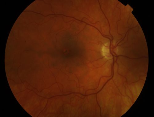 Multiple - Congenital Hypertrophy of the Pigment Epithelium - CHRPE - Gardner Syndrome
63 Year Old woman with a history of colon cancer at age 32.  She has also had thyroid cancer.  Two of her 6 siblings died of cancer, one of sarcoma and one of lung cancer.  Vision 20/30, 20/25.  Fundus shows CHRPE in both eyes.
