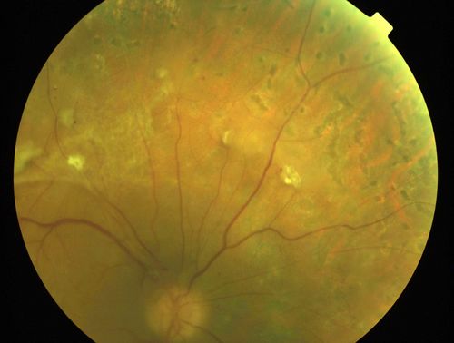 Macula Threatening Diabetic Traction Retinal Detachment - Proliferative Diabetic Retinopathy - Vitreous Hemorrhage
Vision 20/50 but tractional retinal detachment supero-temporally is extending toward fovea and vessels are still active on optic nerve.
