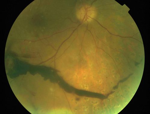 Macula Threatening Diabetic Traction Retinal Detachment - Proliferative Diabetic Retinopathy - Vitreous Hemorrhage
Vision 20/50 but tractional retinal detachment supero-temporally is extending toward fovea and vessels are still active on optic nerve.
