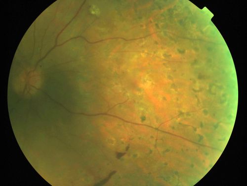 Macula Threatening Diabetic Traction Retinal Detachment - Proliferative Diabetic Retinopathy - Vitreous Hemorrhage
Vision 20/50 but tractional retinal detachment supero-temporally is extending toward fovea and vessels are still active on optic nerve.
