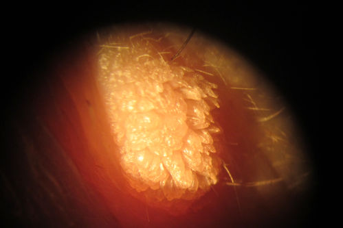 Lid Verruca Vulgaris
