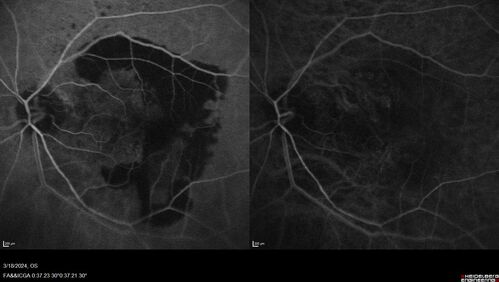 Idiopathic Polypoidal Choroidal Vasculopathy
83 year old man with wet AMD for 12 years resistant to Anti-VEGF therapy but responsive to PDT
