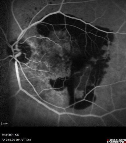 Idiopathic Polypoidal Choroidal Vasculopathy
83 year old man with wet AMD for 12 years resistant to Anti-VEGF therapy but responsive to PDT
