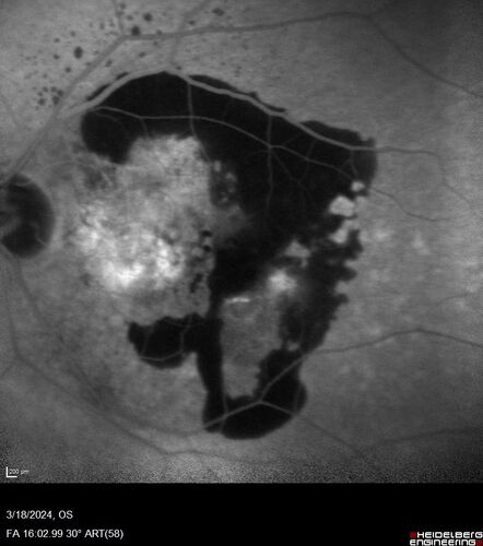 Idiopathic Polypoidal Choroidal Vasculopathy
83 year old man with wet AMD for 12 years resistant to Anti-VEGF therapy but responsive to PDT
