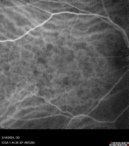Idiopathic Polypoidal Choroidal Vasculopathy
83 year old man with wet AMD for 12 years resistant to Anti-VEGF therapy but responsive to PDT
