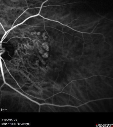 Idiopathic Polypoidal Choroidal Vasculopathy
83 year old man with wet AMD for 12 years resistant to Anti-VEGF therapy but responsive to PDT

