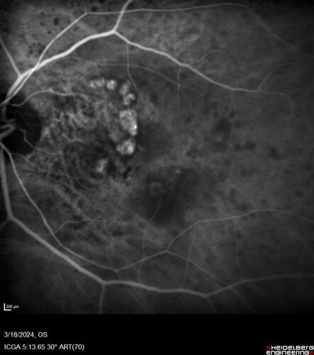 Idiopathic Polypoidal Choroidal Vasculopathy
83 year old man with wet AMD for 12 years resistant to Anti-VEGF therapy but responsive to PDT
