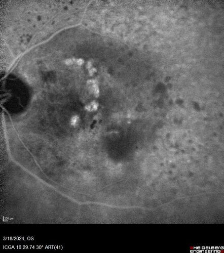 Idiopathic Polypoidal Choroidal Vasculopathy
83 year old man with wet AMD for 12 years resistant to Anti-VEGF therapy but responsive to PDT
