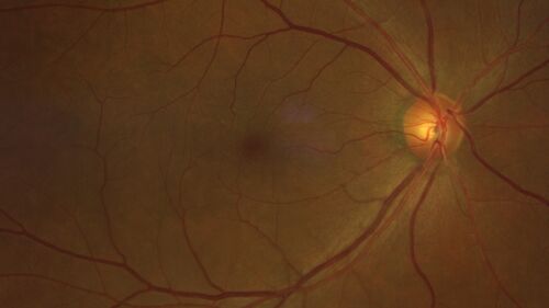 Occult Choroidal Neovascular Membrane
66 year old man with vision loss in the left eye for 2 months
VA 20/20 OD, 20/63 OS
