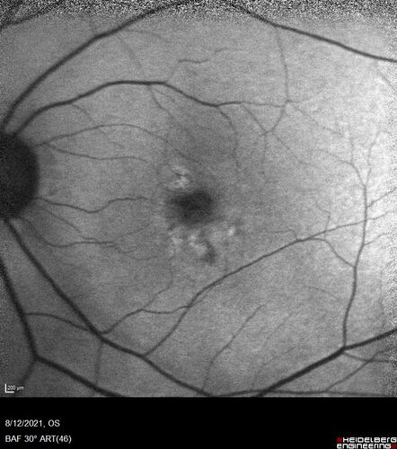 Occult Choroidal Neovascular Membrane
66 year old man with vision loss in the left eye for 2 months
VA 20/20 OD, 20/63 OS
