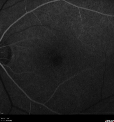 Occult Choroidal Neovascular Membrane
66 year old man with vision loss in the left eye for 2 months
VA 20/20 OD, 20/63 OS
