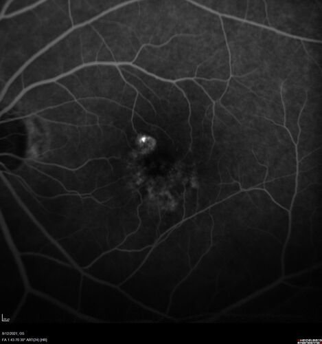 Occult Choroidal Neovascular Membrane
66 year old man with vision loss in the left eye for 2 months
VA 20/20 OD, 20/63 OS
